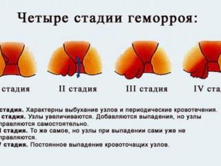 Геморрой у мужчин после операции